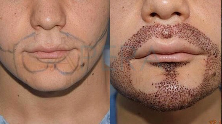 Beard Hair Transplant
